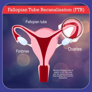 Fallopian Tube Recanalization (FTR)
