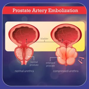 Prostatic Artery Embolization (PAE)