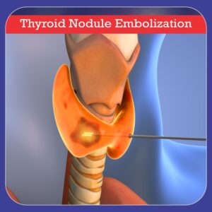 Thyroid Nodule Embolization