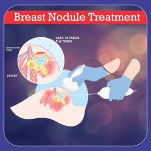 breast nodule treatment