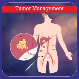tumor management