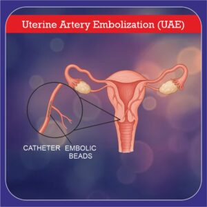 uterine artery embolization