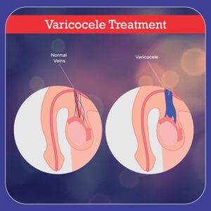 varicocele treatment
