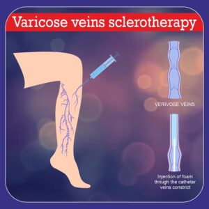 Varicose veins sclerotherapy