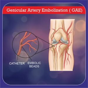 GAE for Knee Pain